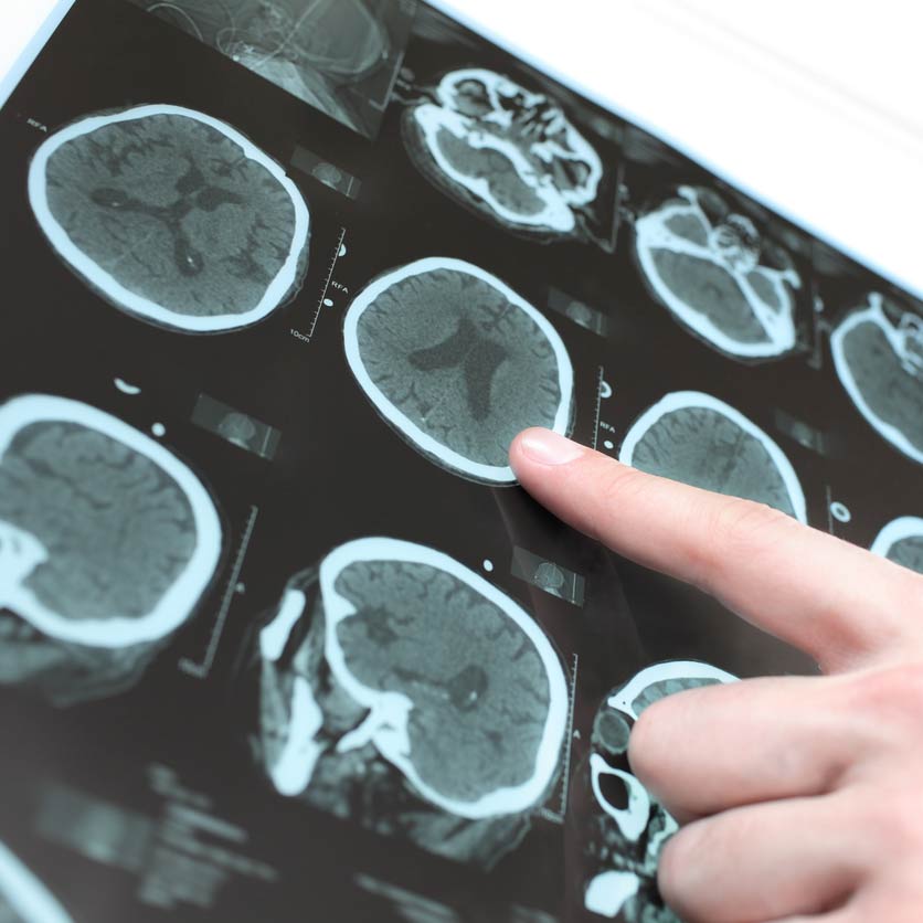 Parkinson’s Symptoms